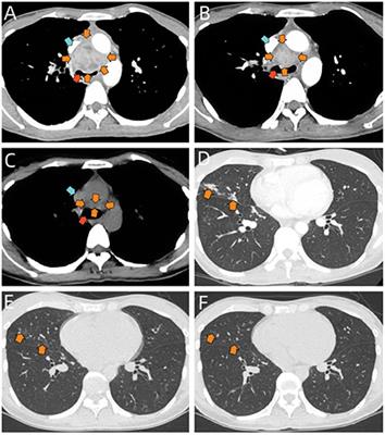 Case report: Acute Talaromyces marneffei mediastinitis in an HIV-negative patient